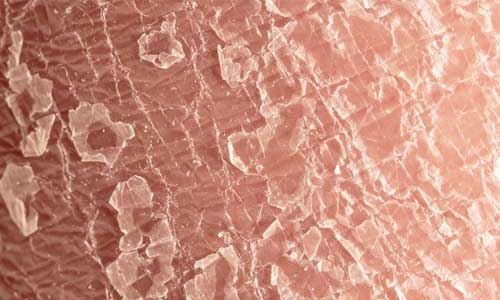 Dry skin on human, explaining the diference between dry skin and eczema