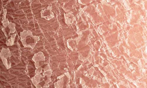 Dry skin on human, explaining the diference between dry skin and eczema